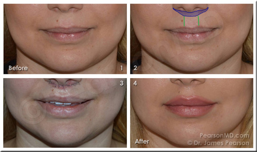 Lip Lift Before After Photo