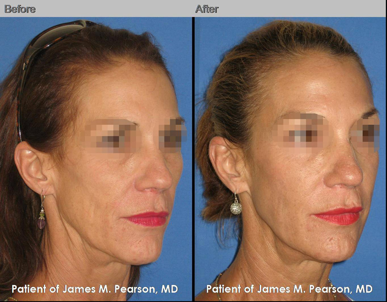 Photo Dr. Pearson Cosmetic Treatment