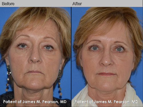 Skin Treatment Photos - Dr. Pearson