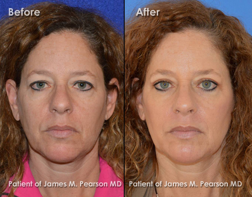 Pearson Eyelid Surgery Photo