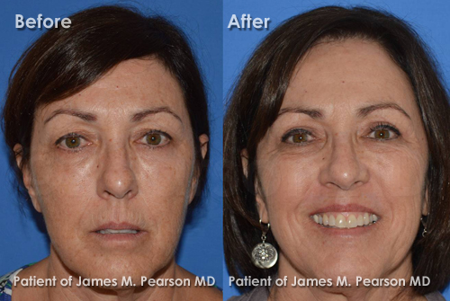 Pearson Eyelid Rejuvenation Photo