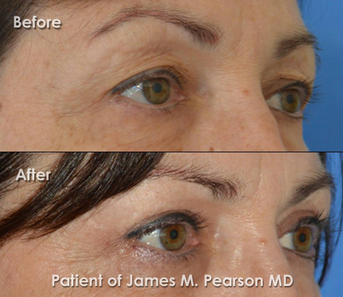 Pearson Eyelid Surgery Photo