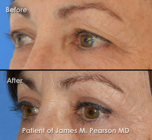 Pearson Eyelid Lift Photo