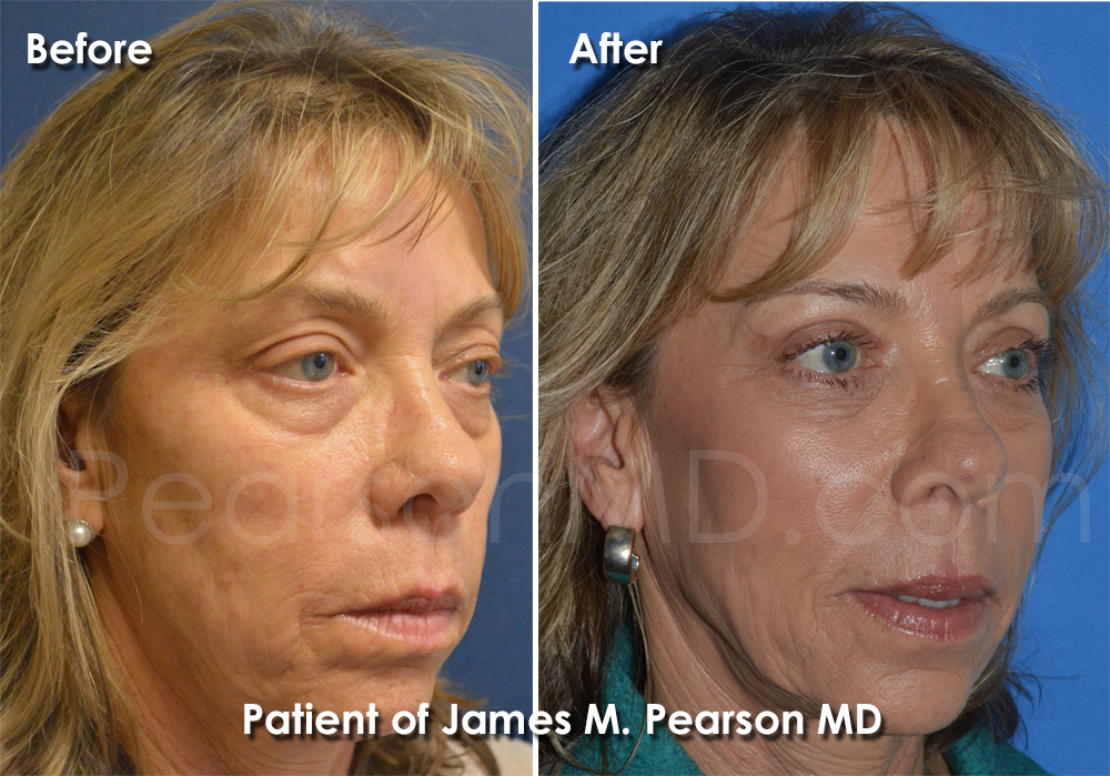 Dr. Pearson Eyelid Surgery Photo