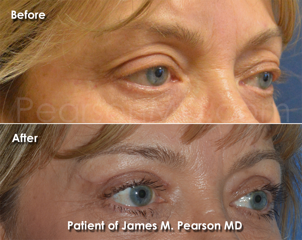 Dr. Pearson Eyelid Surgery Photo