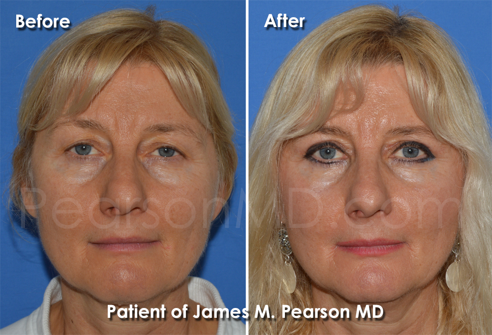 Pearson Eyelid Plastic Surgery Photo