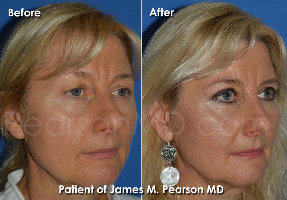 Pearson Eyelid Surgery Photo