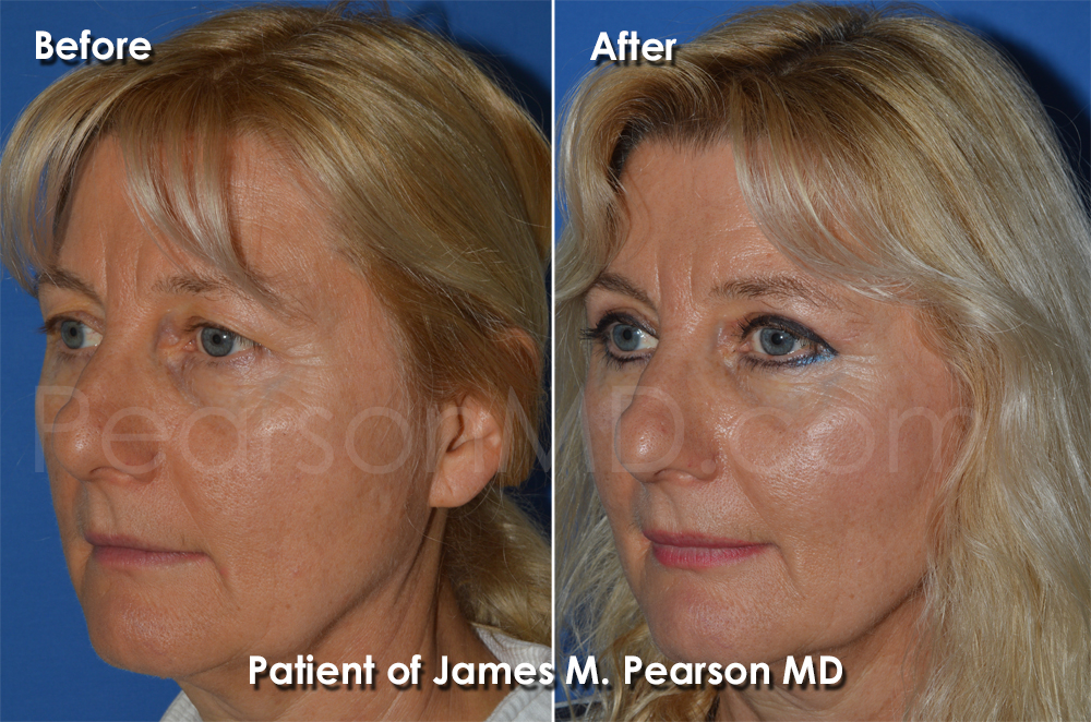 Dr. Pearson Eyelid Surgery Photo