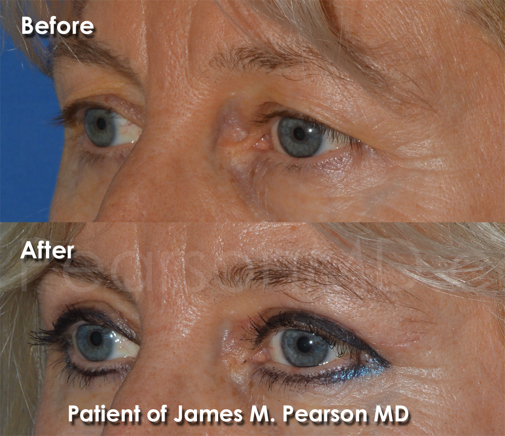 Pearson Eyelid Surgery Photo