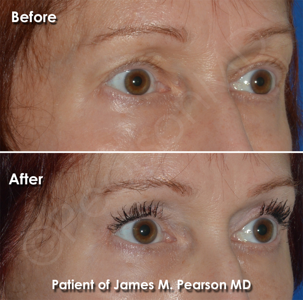 Dr. Pearson Eyelid Surgery Photo