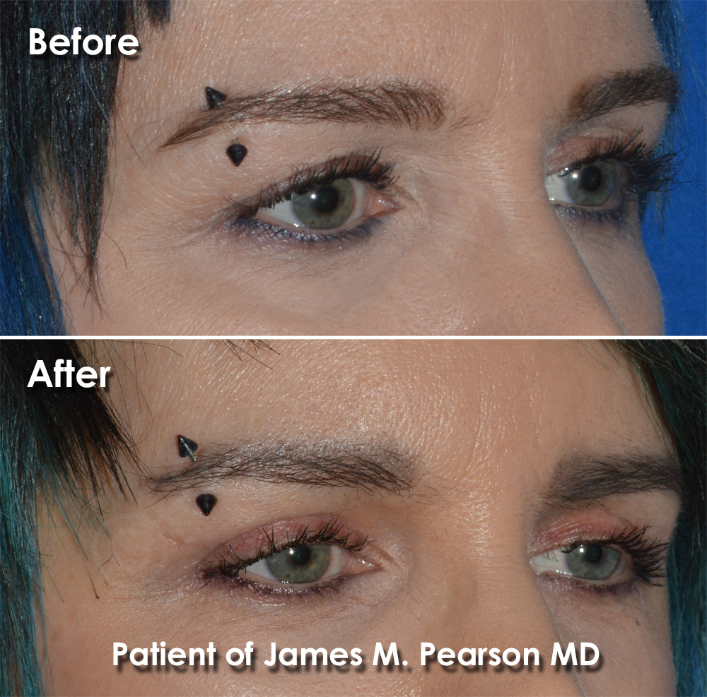 Pearson Cosmetic Eyelid Surgery Photo