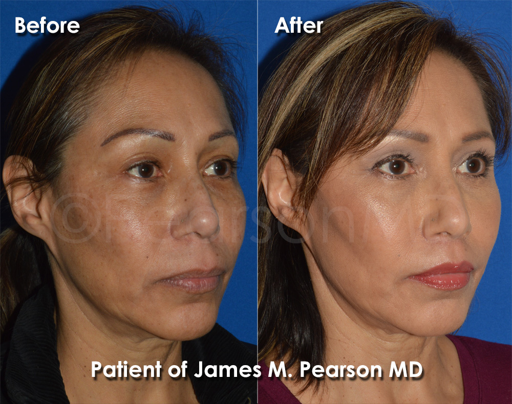 Pearson Plastic Surgery Photo