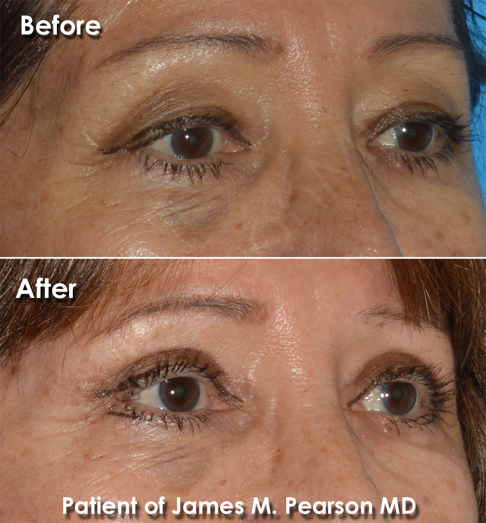Dr. Pearson Eyelid Surgery Photo