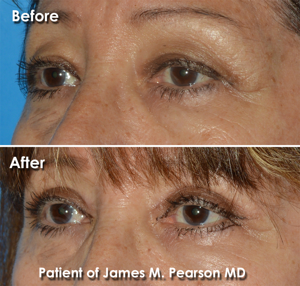 Dr. Pearson Eyelid Surgery Photo