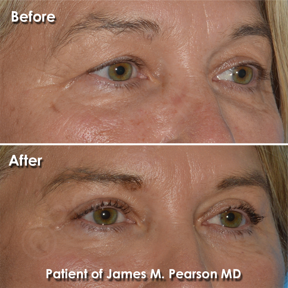 Dr. Pearson Facial Plastic Surgeon
