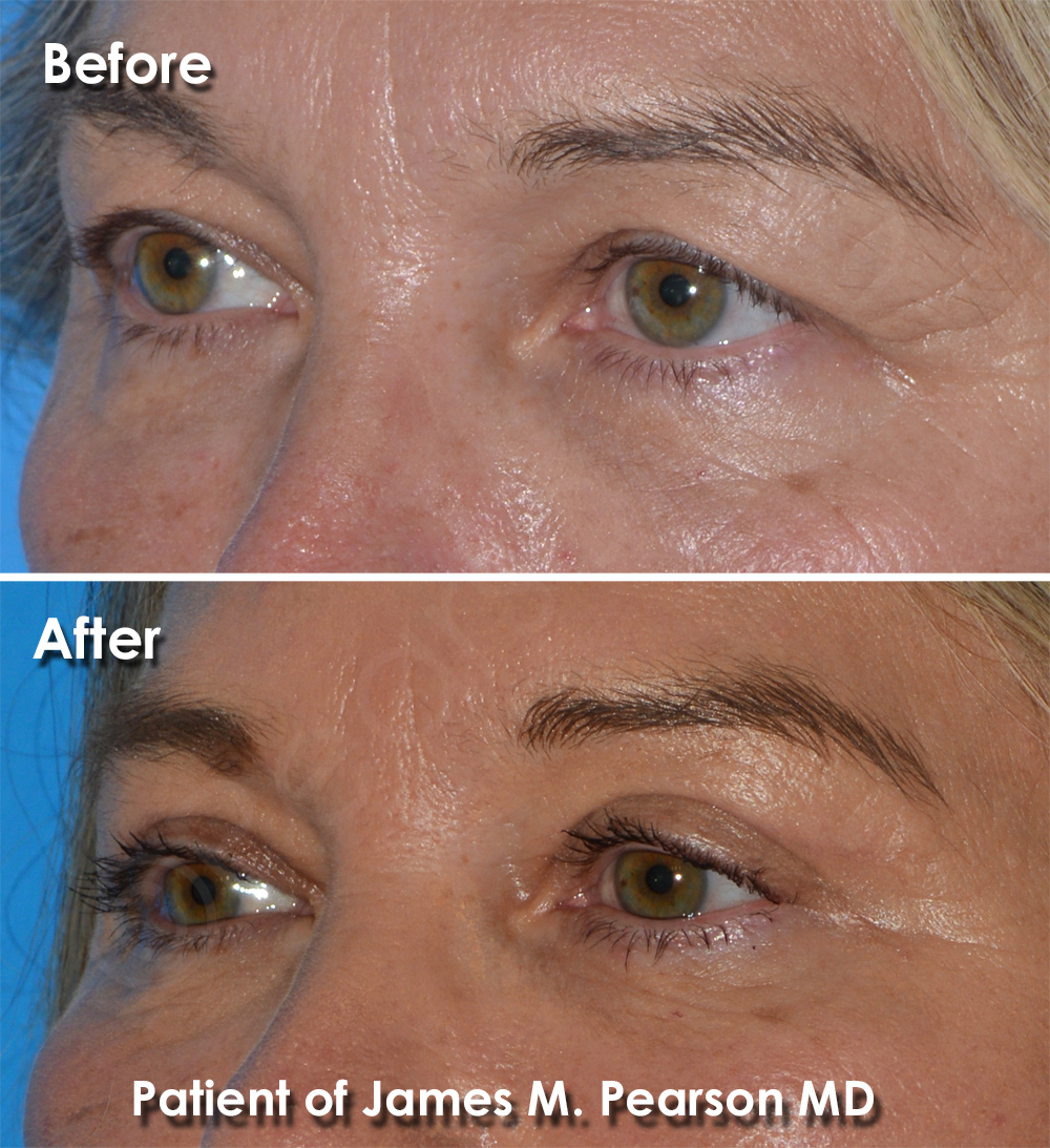 Dr. Pearson Plastic Surgeon