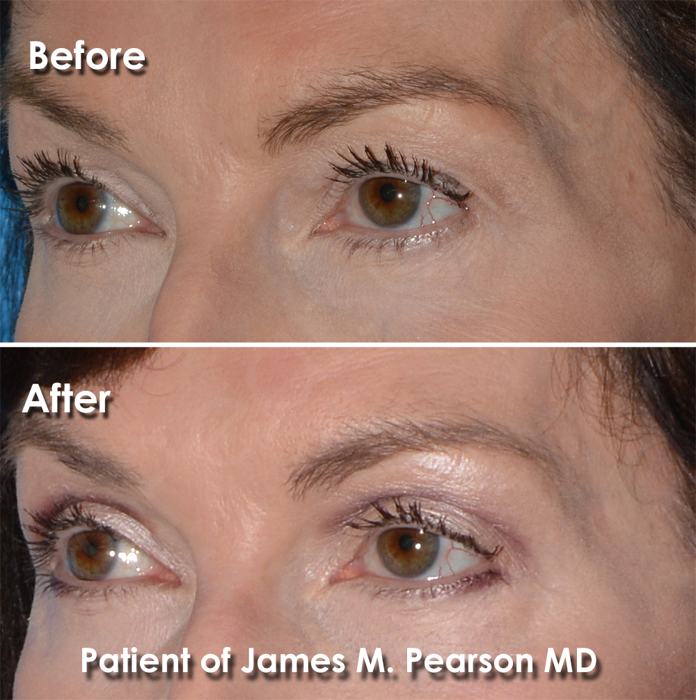 Dr. Pearson Facial Plastic Surgeon