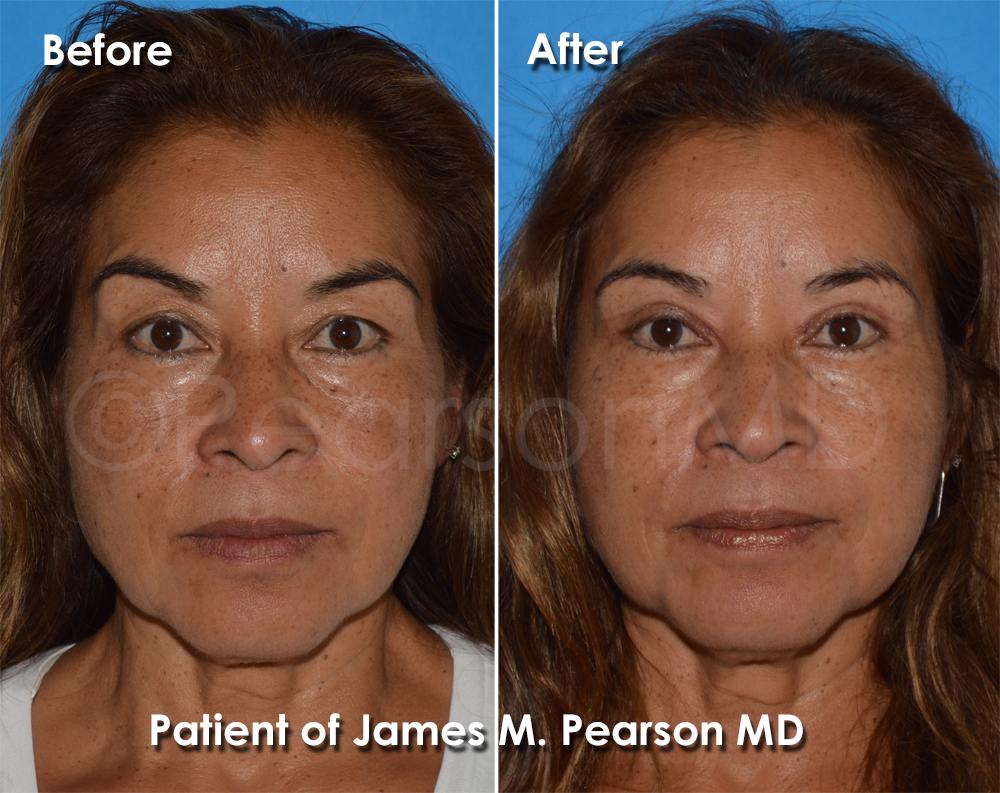 Dr. Pearson Facial Plastic Surgeon
