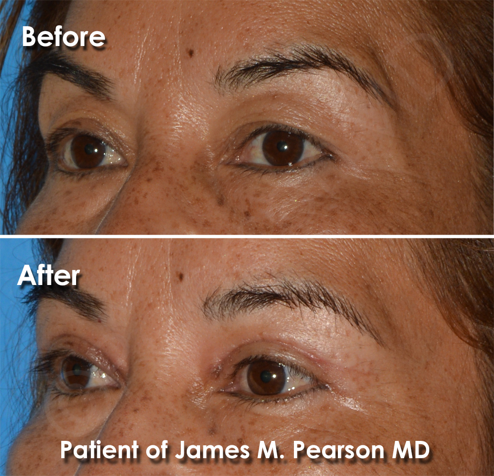 Dr. Pearson Facial Plastic Surgeon