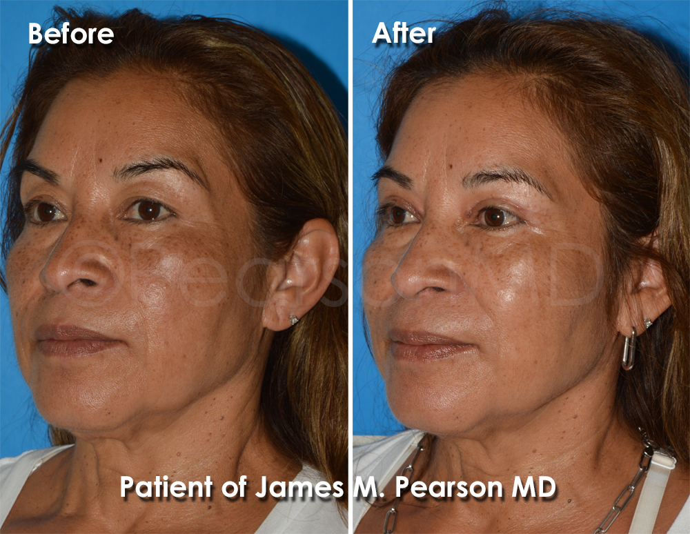 Dr. Pearson Facial Plastic Surgeon