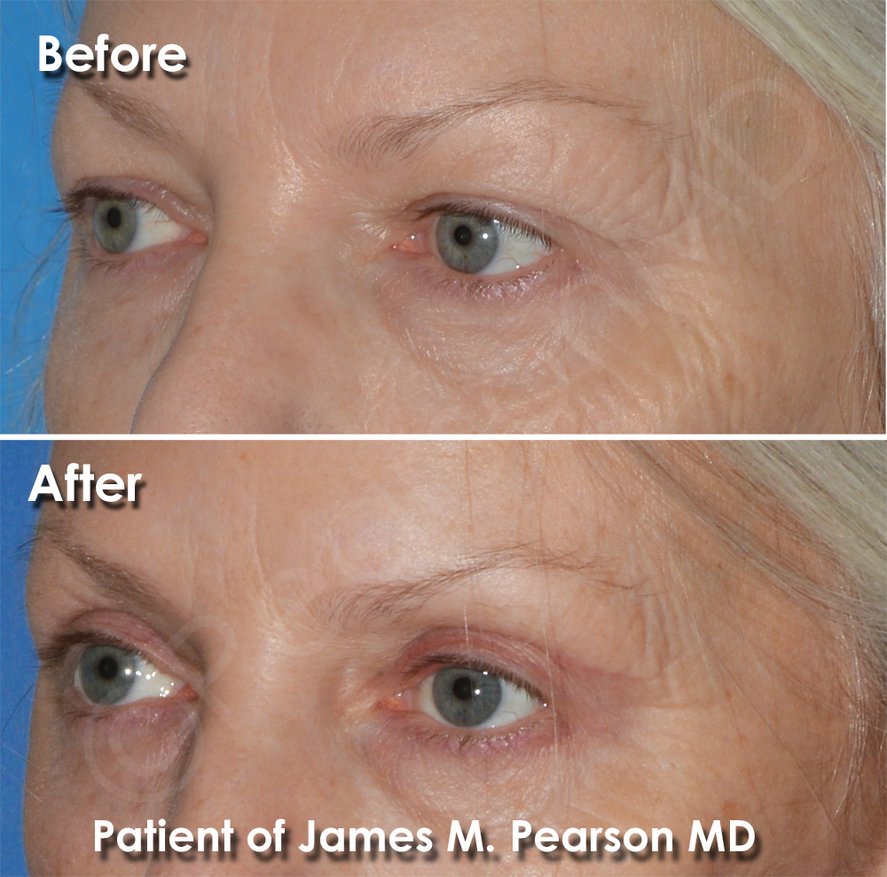 Dr. Pearson Facial Plastic Surgeon