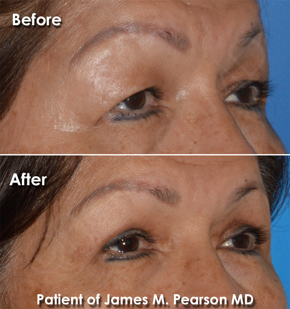 Dr. Pearson Facial Plastic Surgeon