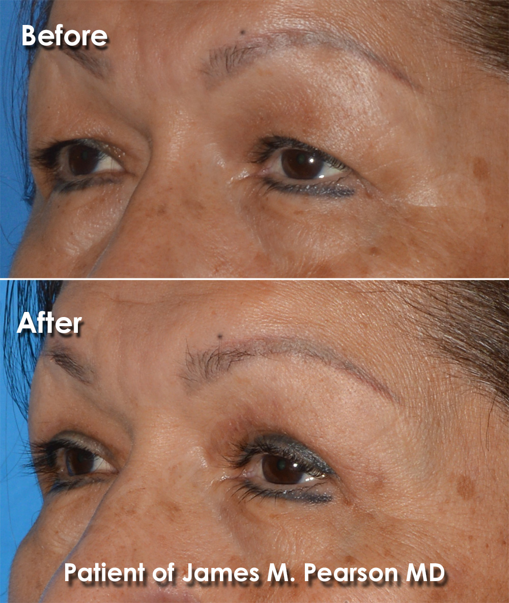 Dr. Pearson Facial Plastic Surgeon