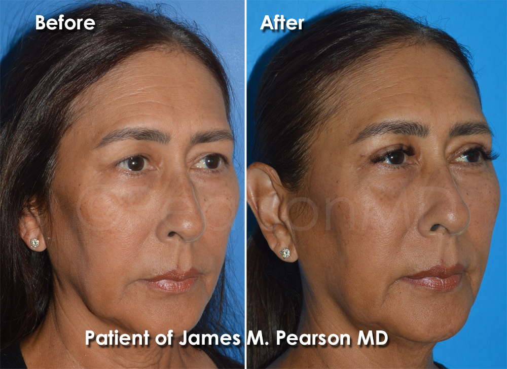 Pearson Eyelid Lift
