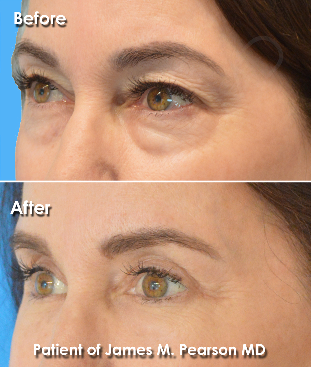 Dr. Pearson Facial Plastic Surgeon