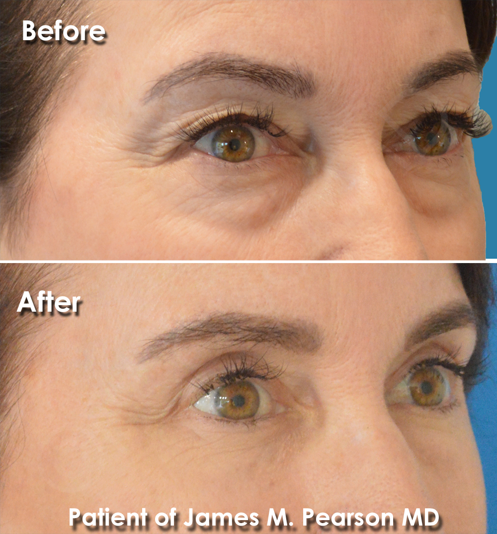 Dr. Pearson Facial Plastic Surgeon
