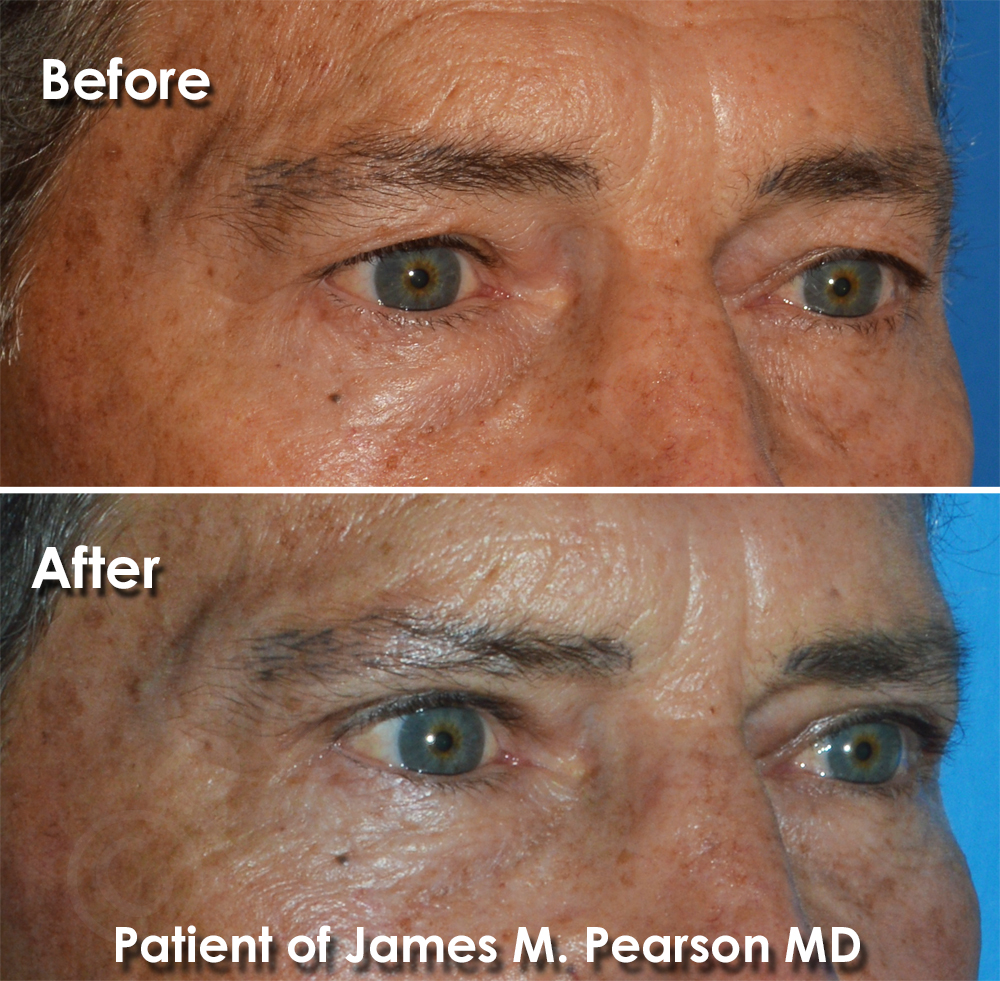 Dr. Pearson Facial Plastic Surgeon