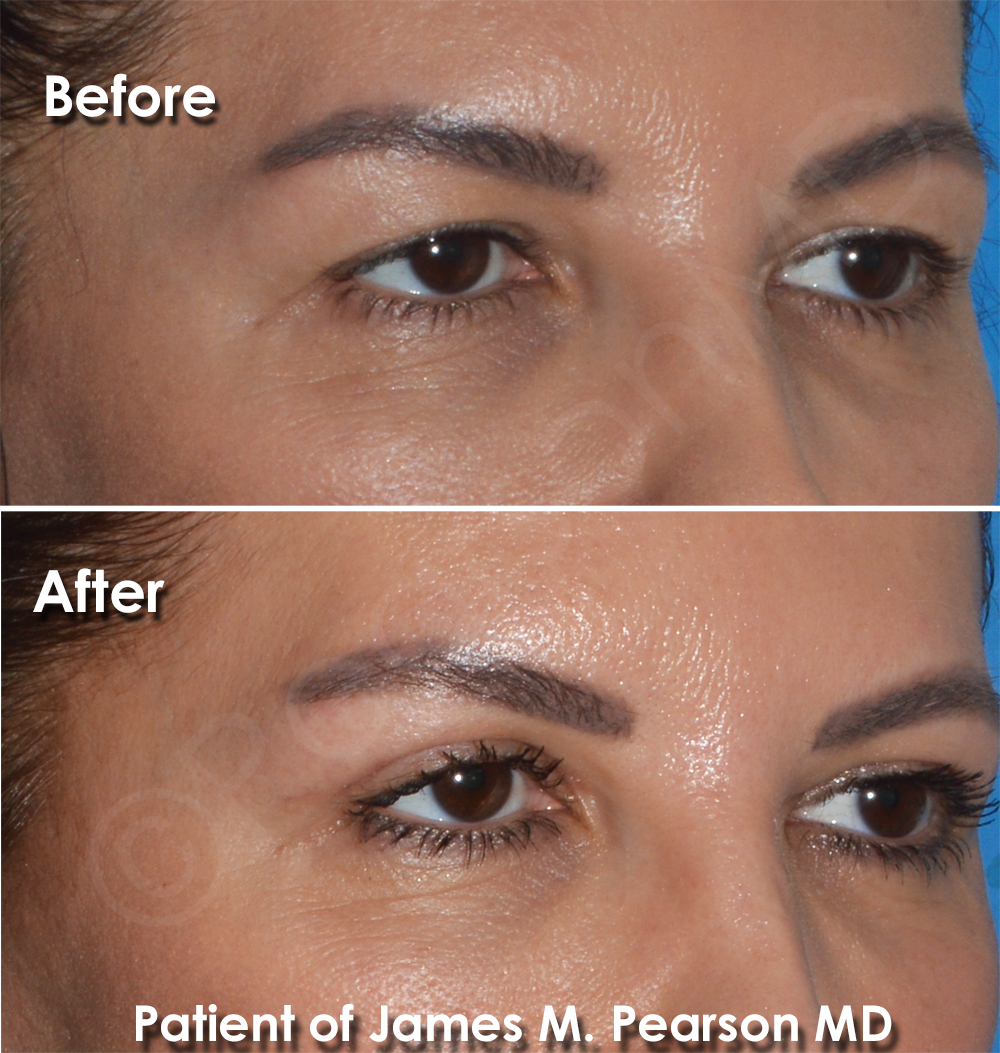 Dr. Pearson Facial Plastic Surgeon