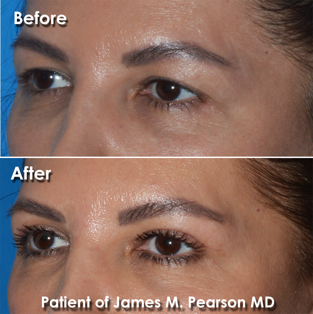 Dr. Pearson Facial Plastic Surgeon