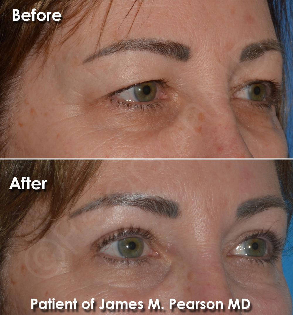 Dr. Pearson Facial Plastic Surgeon