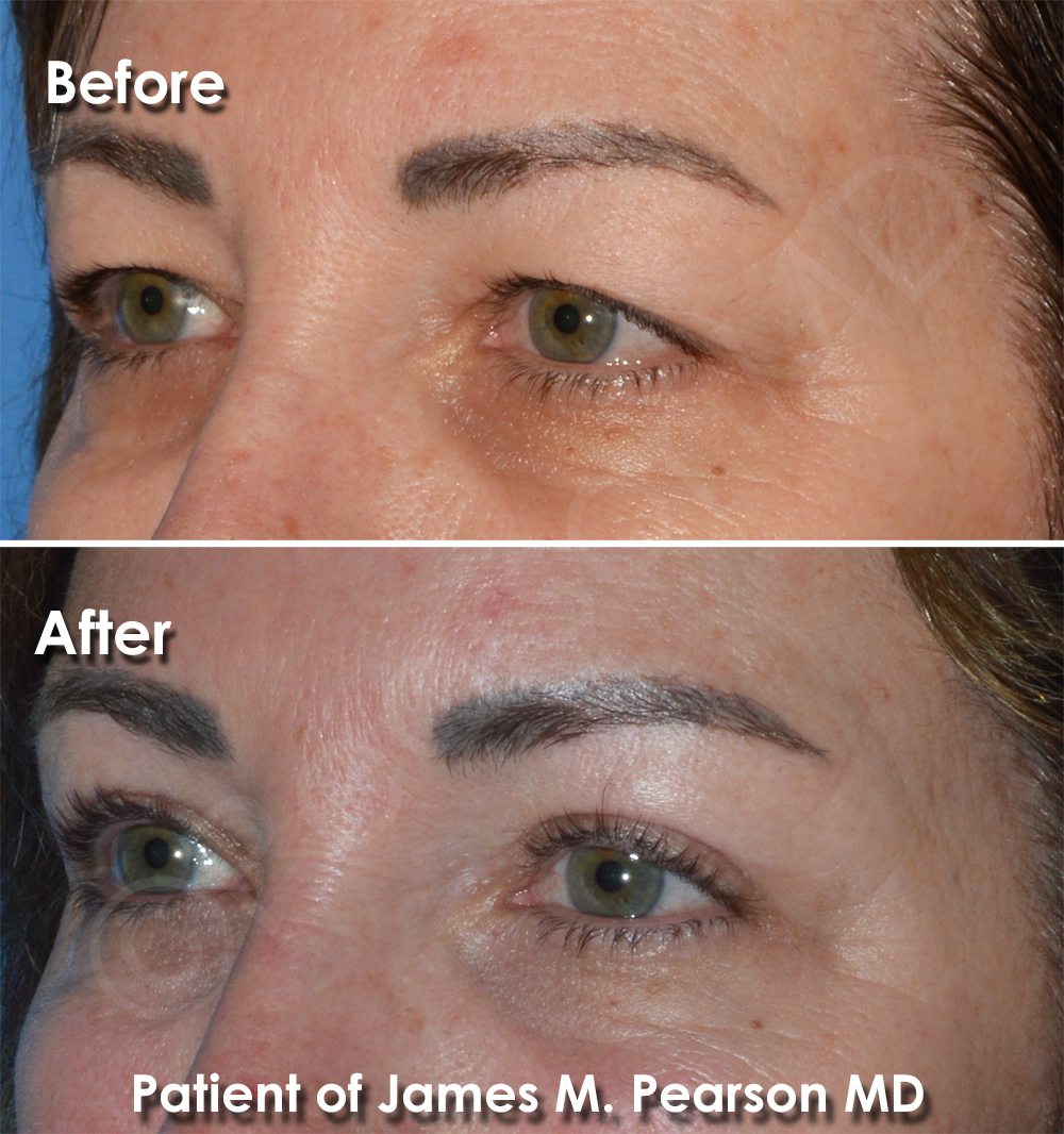 Dr. Pearson Facial Plastic Surgeon