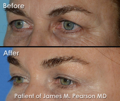 Pearson Browlift Photo 21i