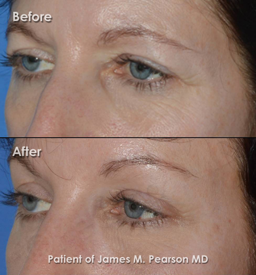 Pearson Forehead lift Photo