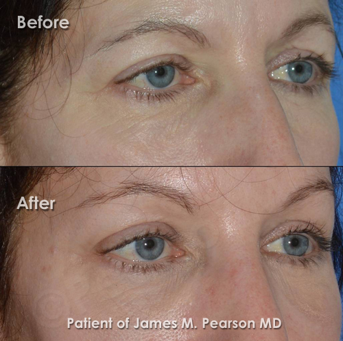 Pearson Endoscopic Browlift Photo