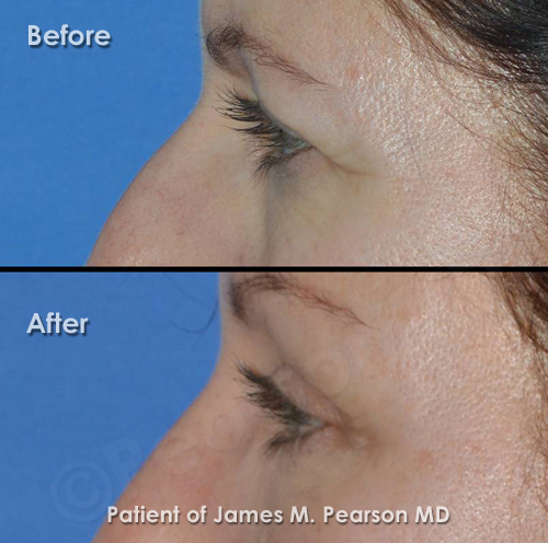 Pearson Browlift Photo