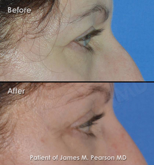 Pearson Endoscopic Forehead lift Photo
