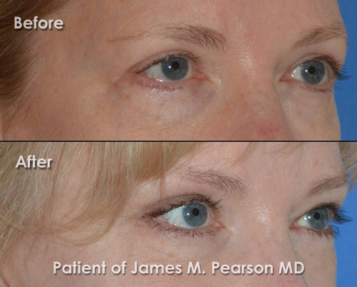 Pearson Forehead Rejuvenation Photo