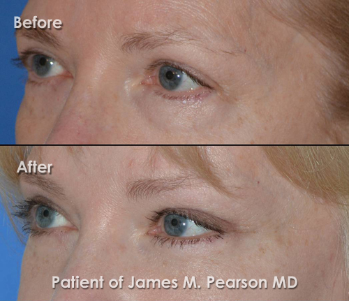 Pearson Forehead Lift Photo