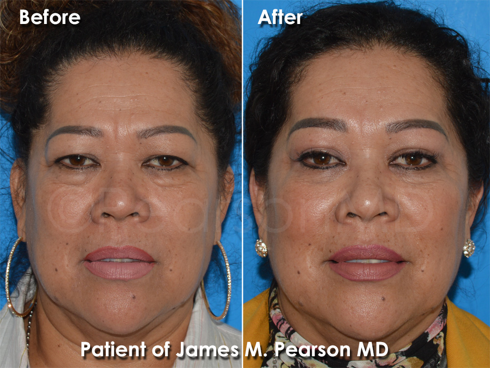 Pearson Plastic Surgery
