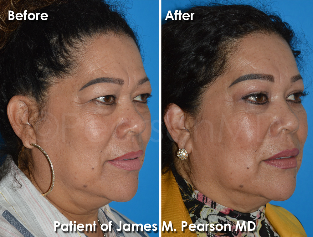 Pearson Plastic Surgery