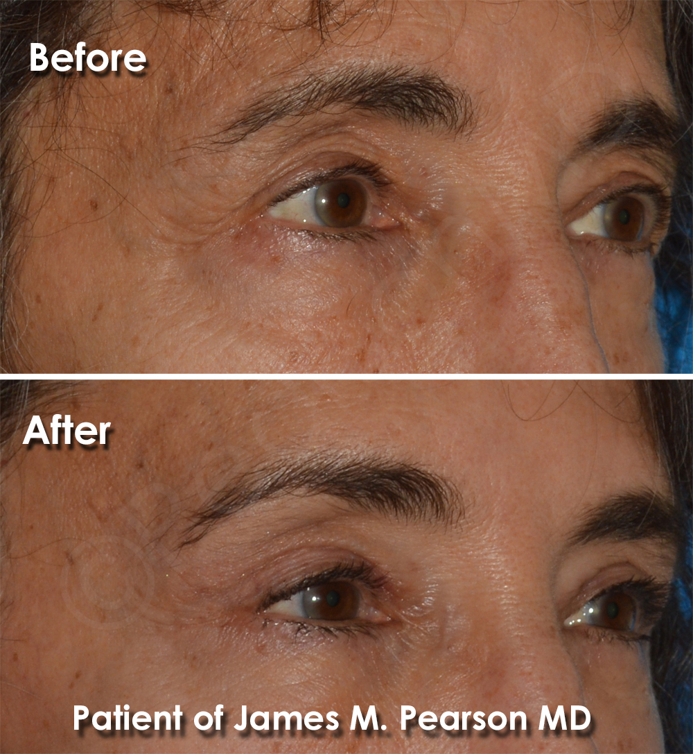 Dr. Pearson Brow Lift