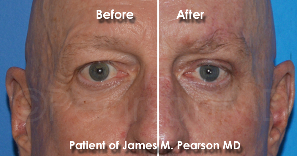 Direct Brow Lift Dr. Pearson