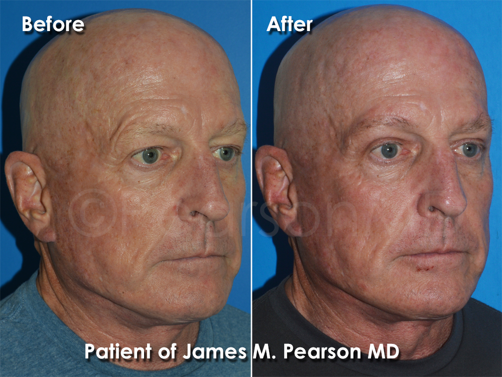 Brow Lift Dr. James Pearson Facial Plastic Surgery