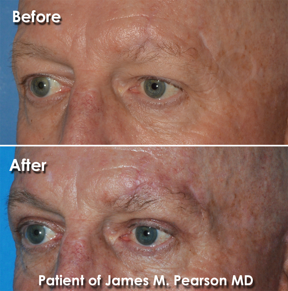 Dr. Pearson Browlift Blepharoplasty