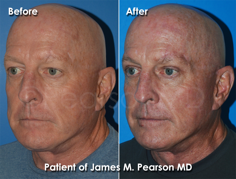 Dr. Pearson Browlift Blepharoplasty
