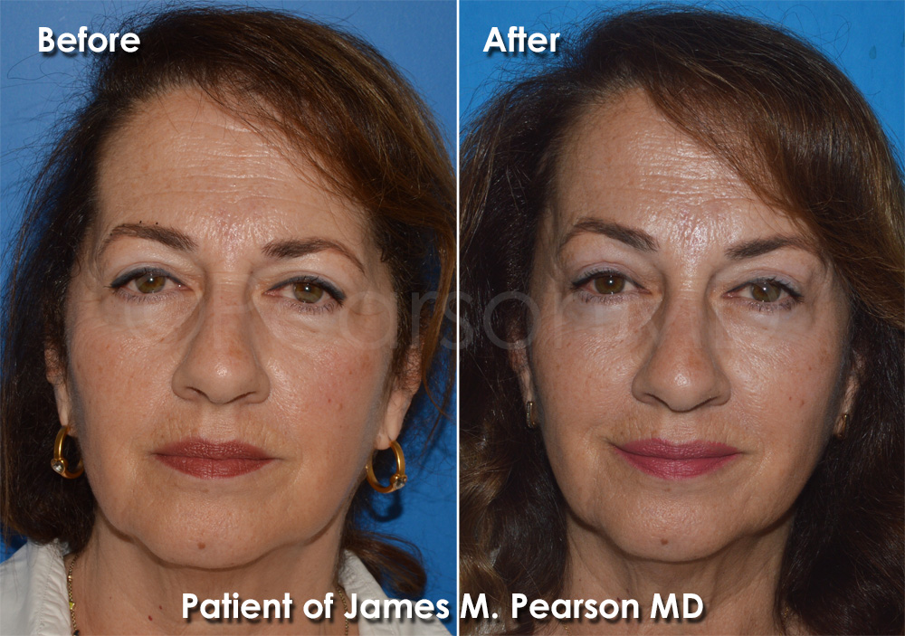 Brow Lift Pearson Plastic Surgery